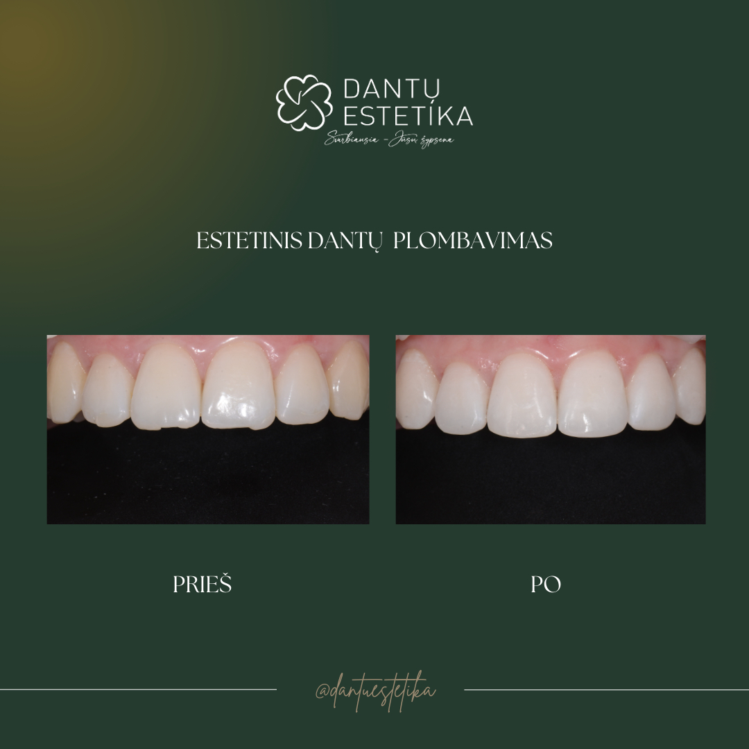 estetinis dantų plombavimas Paciento atvėjis