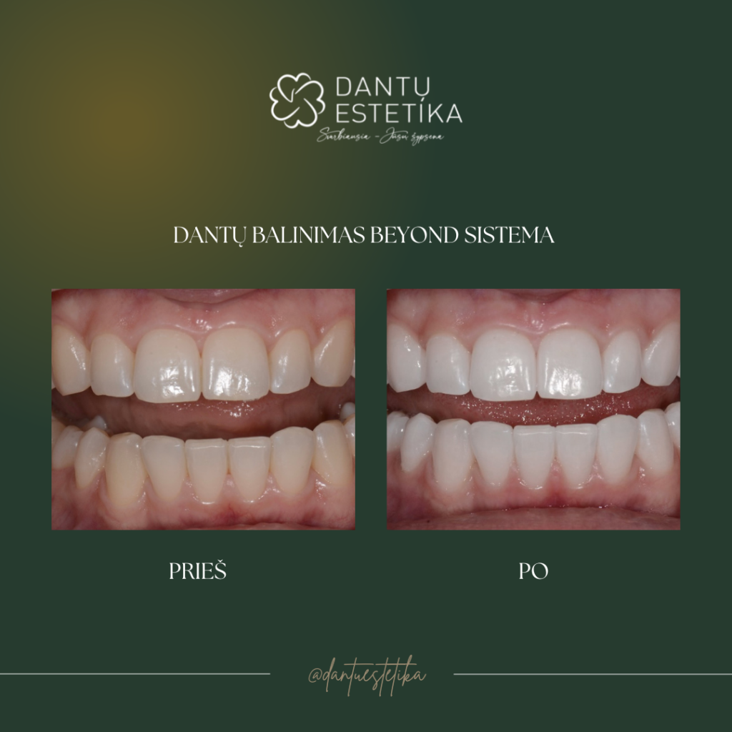 dantų balinimas
