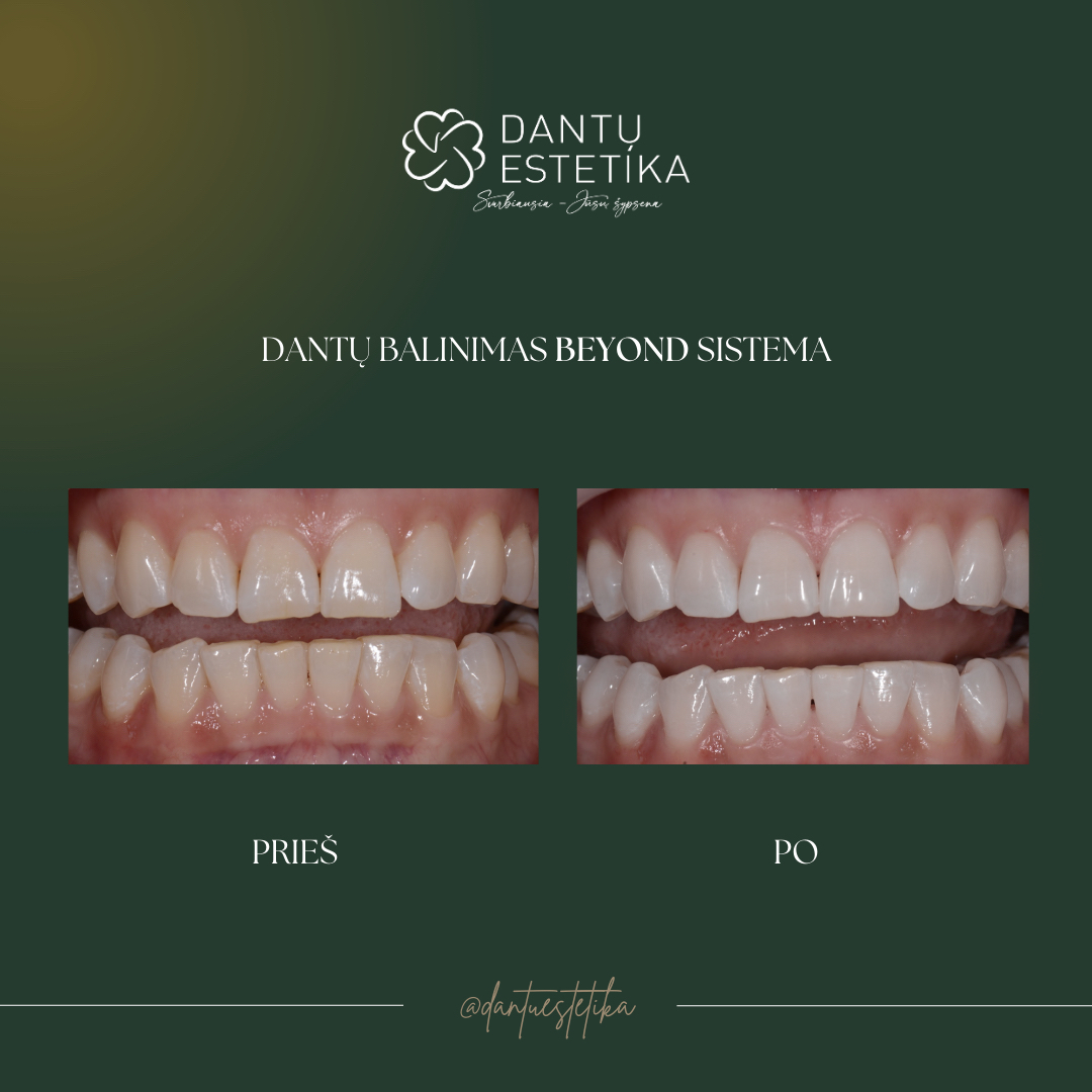 dantų balinimas