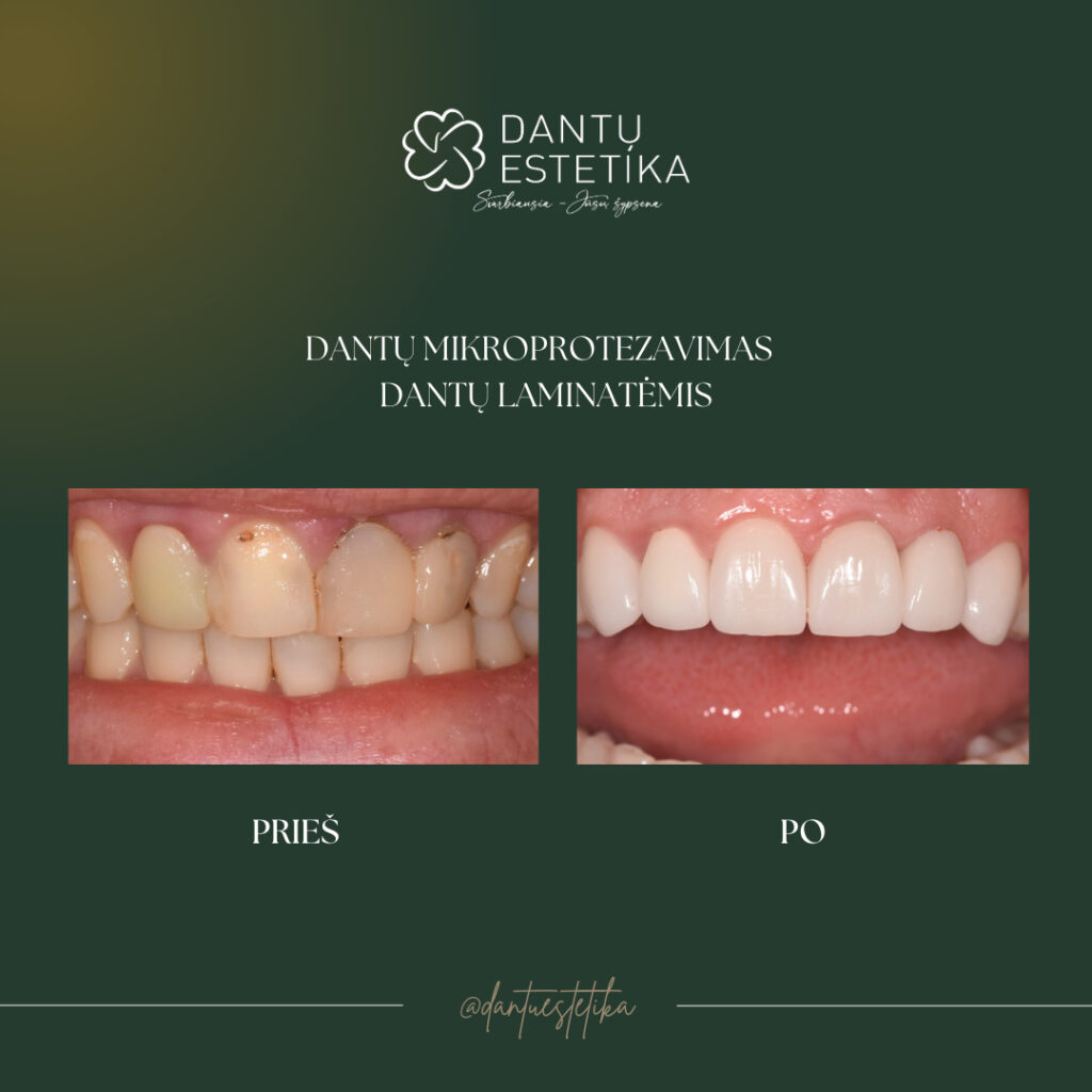 estetinis dantu mikroprotezavimas dantu laminatemis DANTU ESTETIKA klinikoje